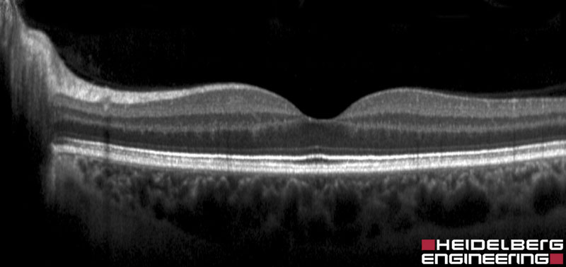 OCT-Aufnahme einer gesunden Netzhaut
